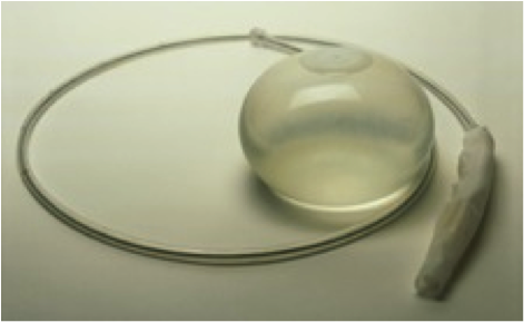 Orbera balloon - ORBERA® Intragastric Balloon