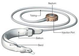 Realize%20band1 - Lap Band Surgery