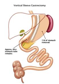 Sleeve - Gastric Sleeve Surgery Brisbane