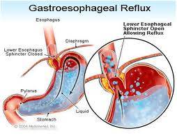 Gastro-Oesophageal-Reflux-Disease
