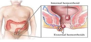 Haemorrhoids2