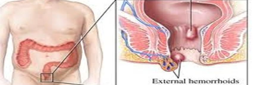 Haemorrhoids2