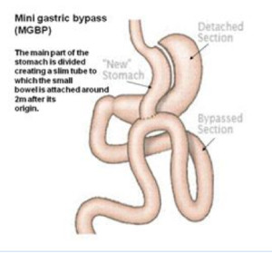 MGBP 300x279 - One Anastomosis Gastric Bypass (OAGB) Formerly Mini Gastric Bypass Surgery